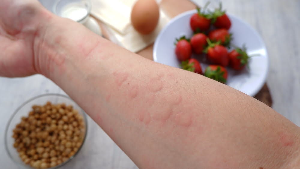 Food Allergies