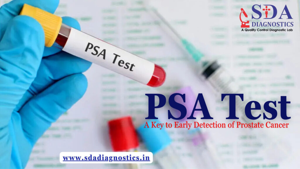 PSA Test: A Key to Early Detection of Prostate Cancer