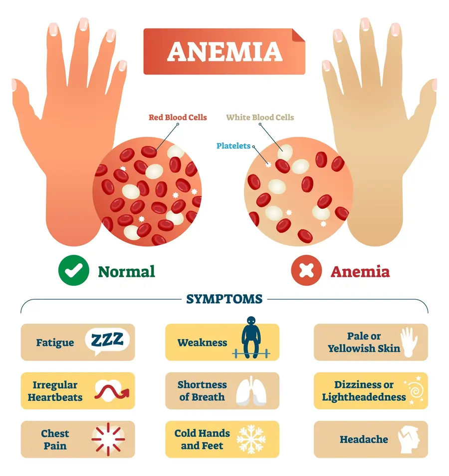 Anemia Low Hemoglobin