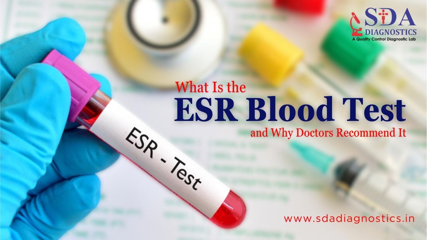 What Is the ESR Blood Test and Why Doctors Recommend It